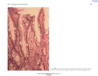 C10 Patología del aparato digestivo 187
FIGURA 10-9. Gastritis crónica atrófica con metaplasia intestinal. Entre las células columna-
res de tipo foveolar hay células caliciformes idénticas a las del intestino delgado y colon.
© 2007 Editorial Médica Panamericana, S.A de C.V.
Cisfarm
 