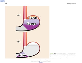 188 Patología especial
FIGURA 10-10. Topografía del estómago. a) Gastritis crónica tipo
A o autoinmune. Las alteraciones inflamatorias y los cambios meta-
plásicos predominan en el cuerpo y fondo. b) Gastritis crónica tipo
B o antral. Las alteraciones inflamatorias y los cambios metaplási-
cos predominan en el antro.
© 2007 Editorial Médica Panamericana, S.A de C.V.
Cisfarm
 