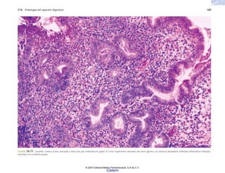 C10 Patología del aparato digestivo 189
FIGURA 10-11. Gastritis crónica activa asociada a infección por Helicobacter pylori. En este espécimen obtenido del antro gástrico se observa abundante infiltrado inflamatorio linfoplas-
mocitario en la lámina propia.
© 2007 Editorial Médica Panamericana, S.A de C.V.
Cisfarm
 