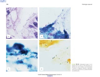 190 Patología especial
FIGURA 10-12. Helicobacter pylori. En la
mayoría de los casos es fácil observar a la
bacteria en cortes teñidos con hematoxilina
y eosina a). Algunas tinciones especiales
como las de Giemsa b) y c) y plata d) facilitan
su identificación.
(b)
(d)
(c)
(a)
© 2007 Editorial Médica Panamericana, S.A de C.V.
Cisfarm
 