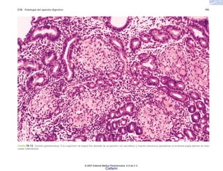C10 Patología del aparato digestivo 191
FIGURA 10-13. Gastritis granulomatosa. Este espécimen de biopsia fue obtenido de un paciente con sarcoidosis y muestra numerosos granulomas en la lámina propia además de otras
células inflamatorias.
© 2007 Editorial Médica Panamericana, S.A de C.V.
Cisfarm
 