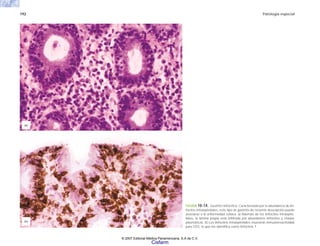192 Patología especial
FIGURA 10-14. Gastritis linfocítica. Caracterizada por la abundancia de lin-
focitos intraepiteliales, este tipo de gastritis de reciente descripción puede
asociarse a la enfermedad celíaca. a) Además de los linfocitos intraepite-
liales, la lámina propia está infiltrada por abundantes linfocitos y células
plasmáticas. b) Los linfocitos intraepiteliales muestran inmunorreactividad
para CD3, lo que los identifica como linfocitos T.
(b)
(a)
© 2007 Editorial Médica Panamericana, S.A de C.V.
Cisfarm
 
