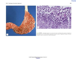 C10 Patología del aparato digestivo 193
FIGURA 10-15. Gastropatía aguda. a) La mucosa de todo el estómago tiene aspecto congestivo y
hemorrágico. b) En la lámina propia superficial se observa edema, congestión vascular y microhe-
morragias. Nótese la ausencia de células inflamatorias.
(b)
(a)
© 2007 Editorial Médica Panamericana, S.A de C.V.
Cisfarm
 