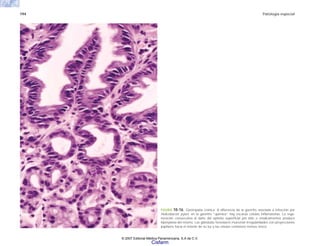 194 Patología especial
FIGURA 10-16. Gastropatía crónica. A diferencia de la gastritis asociada a infección por
Helicobacter pylori, en la gastritis “química” hay escasas células inflamatorias. La rege-
neración consecutiva al daño del epitelio superficial por bilis o medicamentos produce
hiperplasia del mismo. Las glándulas foveolares muestran irregularidades con proyecciones
papilares hacia el interior de su luz y las células contienen menos moco.
© 2007 Editorial Médica Panamericana, S.A de C.V.
Cisfarm
 