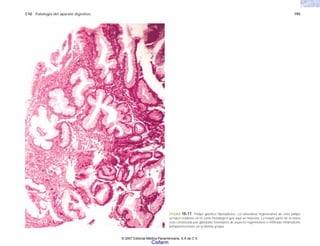 C10 Patología del aparato digestivo 195
FIGURA 10-17. Pólipo gástrico hiperplásico. La naturaleza regenerativa de este pólipo
se hace evidente en el corte histológico que aquí se muestra. La mayor parte de la masa
está constituida por glándulas foveolares de aspecto regenerativo e infiltrado inflamatorio
linfoplasmocitario en la lámina propia.
© 2007 Editorial Médica Panamericana, S.A de C.V.
Cisfarm
 