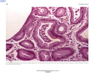 196 Patología especial
FIGURA 10-18. Pólipo gástrico adenomatoso. Este pólipo displásico está constituido por células columnares altas con núcleos hipercromáticos elongados. El aspecto histológico es idéntico
al del adenoma tubular del colon.
© 2007 Editorial Médica Panamericana, S.A de C.V.
Cisfarm
 
