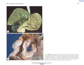 C10 Patología del aparato digestivo 197
FIGURA 10-19. Adenocarcinoma gástrico. a) En este ejemplo, el tumor ha sustituido
casi la totalidad de la superficie del estómago sin producir lesiones elevadas, por lo que
en algunas clasificaciones se le denomina adenocarcinoma de diseminación supeficial.
La compresión extrínseca del colédoco por los ganglios linfáticos metastásicos explica la
dilatación de la vesicula biliar y la colestasis hepática. b) El tumor infiltra difusamente la
pared gástrica a nivel del píloro, produciendo obstrucción del mismo.
(b)
(a)
© 2007 Editorial Médica Panamericana, S.A de C.V.
Cisfarm
 