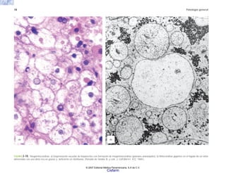 18 Patología general
FIGURA 2-10. Megamitocondrias. a) Degeneración vacuolar de hepatocitos con formación de megamitocondrias (gránulos anaranjados). b) Mitocondrias gigantes en el hígado de un ratón
alimentado con una dieta rica en grasas y deficiente en riboflavina. (Tomado de Tandier B. y cols. J. Cell Biol 41: 472, 1969.)
(b)
(a)
© 2007 Editorial Médica Panamericana, S.A de C.V.
Cisfarm
 