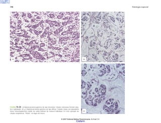 198 Patología especial
FIGURA 10-20. a) Adenocarcioma gástrico de tipo intestinal. Células cohesivas forman túbu-
los o glándulas. b) y c) Adenocarcinoma gástrico de tipo difuso. Células claras con abundante
moco intracitoplásmico (anillo de sello) infiltran de manera individual. En este ejemplo las
células neoplásicas “flotan” en lagos de moco.
(b)
(c)
(a)
© 2007 Editorial Médica Panamericana, S.A de C.V.
Cisfarm
 