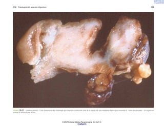 C10 Patología del aparato digestivo 199
FIGURA 10-21. Linfoma gástrico. Corte transversal del estómago que muestra sustitución total de la pared por una neoplasia blanca que recuerda la “carne de pescado”. En la porción
central se observa una úlcera.
© 2007 Editorial Médica Panamericana, S.A de C.V.
Cisfarm
 