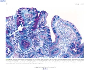 200 Patología especial
FIGURA 10-22. Duodenitis péptica. Mucosa duodenal vecina a una úlcera péptica teñida con tinción de PAS-azul alciano. Las células caliciformes normales del intestino se tiñen de azul
(azul alciano positivas) debido a que contienen mucopolisacáridos ácidos. En el centro de la fotografía se observan dos vellosidades parcialmente revestidas por células con citoplasma teñido
de rojo (PAS positivas) debido al alto contenido de mucopolisacáridos neutros. Estas células son semejantes a las células foveolares o superficiales del estómago y representan zonas de
metaplasia gástrica. En las vellosidades del duodeno normal no hay células PAS positivas.
© 2007 Editorial Médica Panamericana, S.A de C.V.
Cisfarm
 
