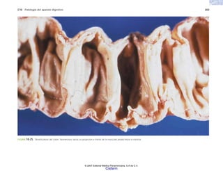 C10 Patología del aparato digestivo 203
FIGURA 10-25. Diverticulosis del colon. Numerosos sacos se proyectan a través de la muscular propia hacia el exterior.
© 2007 Editorial Médica Panamericana, S.A de C.V.
Cisfarm
 