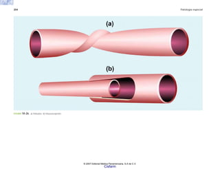 204 Patología especial
FIGURA 10-26. a) Vólvulos. b) Intususcepción.
© 2007 Editorial Médica Panamericana, S.A de C.V.
Cisfarm
 