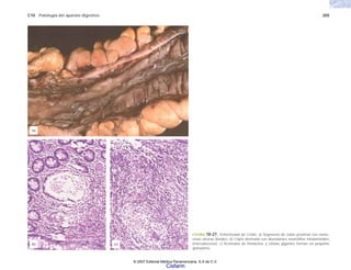 C10 Patología del aparato digestivo 205
FIGURA 10-27. Enfermedad de Crohn. a) Segmento de colon proximal con nume-
rosas úlceras lineales. b) Cripta destruida con abundantes neutrófilos intraluminales
(microabsceso). c) Acúmulos de histiocitos y células gigantes forman un pequeño
granuloma.
(b) (c)
(a)
© 2007 Editorial Médica Panamericana, S.A de C.V.
Cisfarm
 