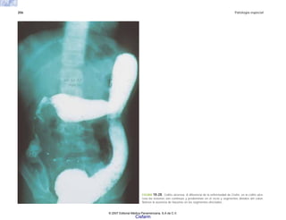 206 Patología especial
FIGURA 10-28. Colitis ulcerosa. A diferencia de la enfermedad de Crohn, en la colitis ulce-
rosa las lesiones son continuas y predominan en el recto y segmentos distales del colon.
Nótese la ausencia de haustras en los segmentos afectados.
© 2007 Editorial Médica Panamericana, S.A de C.V.
Cisfarm
 