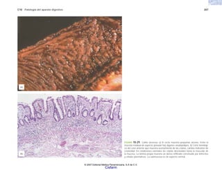 C10 Patología del aparato digestivo 207
FIGURA 10-29. Colitis ulcerosa. a) El recto muestra pequeñas úlceras. Entre la
mucosa residual de aspecto granular hay algunos seudopólipos. b) Corte histológi-
co del caso anterior que muestra acortamiento de las criptas, cambio indicativo de
cronicidad. En condiciones normales las criptas descienden hasta la muscular de
la mucosa. La lámina propia muestra un denso infiltrado constituido por linfocitos
y células plasmáticas. La submucosa es de aspecto normal.
(b)
(a)
© 2007 Editorial Médica Panamericana, S.A de C.V.
Cisfarm
 
