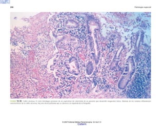 208 Patología especial
FIGURA 10-30. Colitis ulcerosa. El corte histológico proviene de un espécimen de colectomía de un paciente que desarrolló megacolon tóxico. Además de los cambios inflamatorios
característicos de la colitis ulcerosa, hay una úlcera profunda que se observa a la izquierda de la fotografía.
© 2007 Editorial Médica Panamericana, S.A de C.V.
Cisfarm
 