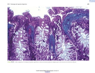C10 Patología del aparato digestivo 209
FIGURA 10-31. Colitis colagenosa. Por debajo del epitelio superficial se observa una densa banda de colágena que se tiñe de azul con la tinción de Masson.
© 2007 Editorial Médica Panamericana, S.A de C.V.
Cisfarm
 