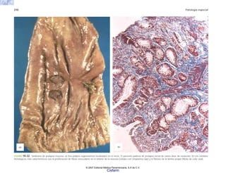 210 Patología especial
FIGURA 10-32. Síndrome de prolapso mucoso. a) Dos pólipos regenerativos localizados en el recto. El paciente padecía de prolapso rectal de varios años de evolución. b) Los cambios
histológicos más característicos son la proliferación de fibras musculares en el interior de la mucosa (células con citoplasma rojo) y la fibrosis de la lámina propia (fibras de color azul).
(b)
(a)
© 2007 Editorial Médica Panamericana, S.A de C.V.
Cisfarm
 