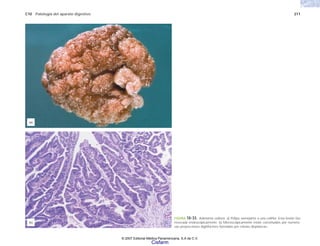 C10 Patología del aparato digestivo 211
FIGURA 10-33. Adenoma velloso. a) Pólipo semejante a una coliflor. Esta lesión fue
resecada endoscópicamente. b) Microscópicamente están constituidos por numero-
sas proyecciones digitiformes formadas por células displásicas.
(b)
(a)
© 2007 Editorial Médica Panamericana, S.A de C.V.
Cisfarm
 