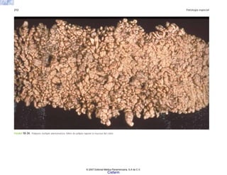 212 Patología especial
FIGURA 10-34. Poliposis múltiple adenomatosa. Miles de pólipos tapizan la mucosa del colon.
© 2007 Editorial Médica Panamericana, S.A de C.V.
Cisfarm
 