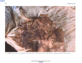 214 Patología especial
FIGURA 10-36. Adenocarcinoma del colon originado en un adenoma velloso. El tejido de aspecto claro en la parte inferior de la fotografía corresponde al carcinoma invasor.
© 2007 Editorial Médica Panamericana, S.A de C.V.
Cisfarm
 
