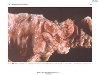 C10 Patología del aparato digestivo 215
FIGURA 10-37. Adenocarcinoma del colon. Este tumor circunferencial corresponde al denominado carcinoma en “anillo de servilleta”. Nótese la dilatación del colon proximal al tumor.
© 2007 Editorial Médica Panamericana, S.A de C.V.
Cisfarm
 