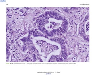 216 Patología especial
FIGURA 10-38. Adenocarcinoma del colon. La mayoría de los tumores forman estructuras glandulares o tubulares constituidas por células columnares altas.
© 2007 Editorial Médica Panamericana, S.A de C.V.
Cisfarm
 