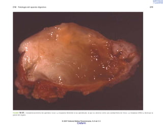 C10 Patología del aparato digestivo 219
FIGURA 10-41. Cistadenocarcinoma del apéndice cecal. La neoplasia distiende la luz apendicular, la que se observa como una cavidad llena de moco. La neoplasia infiltra y destruye la
pared del órgano.
© 2007 Editorial Médica Panamericana, S.A de C.V.
Cisfarm
 