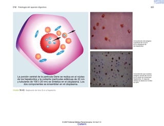 C10 Patología del aparato digestivo 221
FIGURA 10-43. Replicación del virus B en el hepatocito.
Inmunotinción del antígeno
superficial del virus B
en el citoplasma de
los hepatocitos.
Inmunotinción que muestra
antígeno central del virus B
en el núcleo de numerosos
hepatocitos. En algunas
células se observa el núcleo
sin teñir.
© 2007 Editorial Médica Panamericana, S.A de C.V.
Cisfarm
 