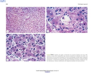 222 Patología especial
FIGURA 10-44. Hepatitis viral aguda. a) Distorsión de las placas hepáticas por focos infla-
matorios y lesión de los hepatocitos, que muestran variación en el tamaño y la tinción. Las
alteraciones son más intensas alrededor de la vena centrolobulillar. b) Globo hialino: hepatocito
intensamente eosinófilo con restos nucleares. Hay infiltración de linfocitos y células de Kupffer
prominentes. c) Degeneración globoide: hepatocito aumentado de tamaño, rodeado por célu-
las inflamatorias; muestra condensación del citoplasma alrededor del núcleo picnótico.
(c)
(b)
(a)
© 2007 Editorial Médica Panamericana, S.A de C.V.
Cisfarm
 
