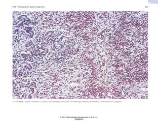 C10 Patología del aparato digestivo 223
FIGURA 10-45. Hepatitis fulminante: se observa necrosis hepatocelular total, con hemorragia, infiltración de linfocitos y neoformación de colangiolos.
© 2007 Editorial Médica Panamericana, S.A de C.V.
Cisfarm
 