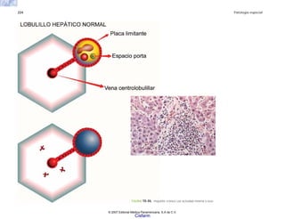 224 Patología especial
FIGURA 10-46. Hepatitis crónica con actividad mínima o leve.
© 2007 Editorial Médica Panamericana, S.A de C.V.
Cisfarm
 