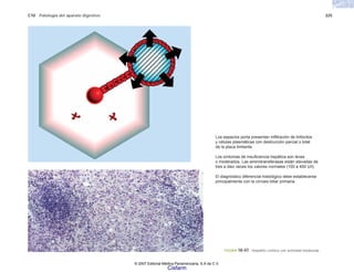 C10 Patología del aparato digestivo 225
FIGURA 10-47. Hepatitis crónica con actividad moderada.
Los espacios porta presentan infiltración de linfocitos
y células plasmáticas con destrucción parcial o total
de la placa limitante.
Los síntomas de insuficiencia hepática son leves
o moderados. Las aminotransferasas están elevadas de
tres a diez veces los valores normales (100 a 400 U/l).
El diagnóstico diferencial histológico debe establecerse
principalmente con la cirrosis biliar primaria.
© 2007 Editorial Médica Panamericana, S.A de C.V.
Cisfarm
 