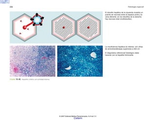 226 Patología especial
FIGURA 10-48. Hepatitis crónica con actividad intensa.
La insuficiencia hepática es intensa, con cifras
de aminotransferasas superiores a 400 U/l.
El diagnóstico diferencial histológico debe
hacerse con la hepatitis fulminante.
El lobulillo hepático de la izquierda muestra un
puente de necrosis entre el espacio porta y la
vena eferente; en los lobulillos de la derecha
hay necrosis total (multilobulillar).
© 2007 Editorial Médica Panamericana, S.A de C.V.
Cisfarm
 