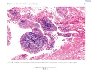 C2 Lesiones en diferentes niveles de organización biológica 21
FIGURA 2-13. Histología de las vellosidades articulares en la artritis reumatoide. Hay proliferación de células sinoviales, infiltración inflamatoria y formación de pannus.
© 2007 Editorial Médica Panamericana, S.A de C.V.
Cisfarm
 