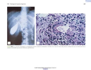 C10 Patología del aparato digestivo 229
FIGURA 10-51. a) Colestasis intrahepática: la colangiografía muestra conductos extrahepáticos normales en un caso de cirrosis biliar primaria. b) Biopsia del caso con destrucción de un
conducto interlobulillar que presenta inflamación granulomatosa.
(b)
(a)
© 2007 Editorial Médica Panamericana, S.A de C.V.
Cisfarm
 