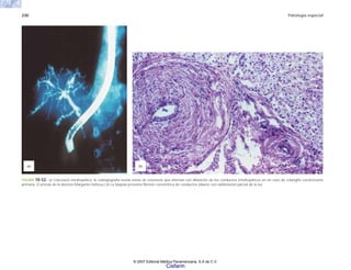 230 Patología especial
FIGURA 10-52. a) Colestasis intrahepática: la colangiografía revela zonas de estenosis que alternan con dilatación de los conductos intrahepáticos en un caso de colangitis esclerosante
primaria. (Cortesía de la doctora Margarita Dehesa.) b) La biopsia presenta fibrosis concéntrica de conductos biliares con obliteración parcial de la luz.
(b)
(a)
© 2007 Editorial Médica Panamericana, S.A de C.V.
Cisfarm
 