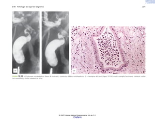 C10 Patología del aparato digestivo 231
(b)
(a)
FIGURA 10-53. a) Colestasis extrahepática: litiasis de vesícula y conductos biliares extrahepáticos. b) La autopsia del caso (figura 10-53a) reveló colangitis bacteriana: conducto septal
con neutrófilos y restos celulares en la luz.
© 2007 Editorial Médica Panamericana, S.A de C.V.
Cisfarm
 