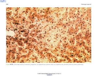 232 Patología especial
FIGURA 10-54. Estasis biliar intensa en canalículos y hepatocitos; los hepatocitos de la porción central, con citoplasma claro, presentan estasis de colatos (colatostasis).
© 2007 Editorial Médica Panamericana, S.A de C.V.
Cisfarm
 