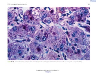 C10 Patología del aparato digestivo 233
FIGURA 10-55. Cirrosis biliar primaria: la mayoría de los hepatocitos presenta en el citoplasma material intensamente eosinófilo que corresponde a cuerpos de Mallory.
© 2007 Editorial Médica Panamericana, S.A de C.V.
Cisfarm
 