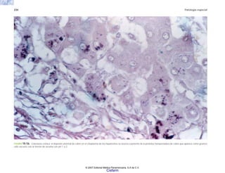 234 Patología especial
FIGURA 10-56. Colestasis crónica: el depósito anormal de cobre en el citoplasma de los hepatocitos se asocia a aumento de la proteína transportadora de cobre que aparece como grumos
café oscuros con la tinción de orceína con pH 1 a 2.
© 2007 Editorial Médica Panamericana, S.A de C.V.
Cisfarm
 