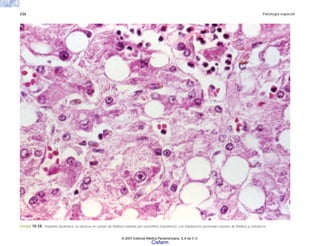 236 Patología especial
FIGURA 10-58. Hepatitis alcohólica: se observa un cuerpo de Mallory rodeado por neutrófilos (satelitosis). Los hepatocitos presentan cuerpos de Mallory y esteatosis.
© 2007 Editorial Médica Panamericana, S.A de C.V.
Cisfarm
 