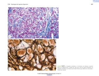 C10 Patología del aparato digestivo 237
FIGURA 10-59. a) Hepatitis alcohólica: el tricrómico de Masson muestra
fibras de colágena tipo I, teñidas de color azul, entre las placas hepáticas. b)
Hepatitis alcohólica con fibrosis pericelular intensa que oblitera los sinusoides.
Tinción de retículo.
(b)
(a)
© 2007 Editorial Médica Panamericana, S.A de C.V.
Cisfarm
 