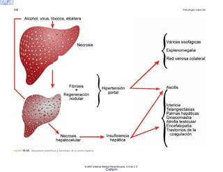238 Patología especial
FIGURA 10-60. Alteraciones anatómicas y funcionales de la cirrosis hepática.
© 2007 Editorial Médica Panamericana, S.A de C.V.
Cisfarm
 