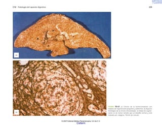 C10 Patología del aparato digestivo 239
FIGURA 10-61. a) Cirrosis de la hemocromatosis con
nódulos de regeneración pequeños y uniformes. b) Aspecto
histológico de la cirrosis micronodular: el nódulo de regene-
ración es de menor tamaño que un lobulillo normal y está
rodeado por colágena. Tinción de retículo.
(b)
(a)
© 2007 Editorial Médica Panamericana, S.A de C.V.
Cisfarm
 