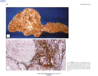 240 Patología especial
FIGURA 10-62. a) Cirrosis macronodular por virus
B. En el lóbulo derecho hay zonas amplias de fibro-
sis, el lóbulo izquierdo presenta atrofia y un carci-
noma hepatocelular (nódulo mayor). b) Cirrosis con
nódulos de regeneración de gran tamaño rodeados
por bandas fibrosas de grosor variable. Tinción de
retículo.
(b)
(a)
© 2007 Editorial Médica Panamericana, S.A de C.V.
Cisfarm
 