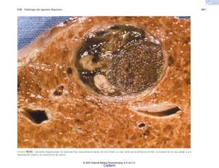 C10 Patología del aparato digestivo 241
FIGURA 10-63. Carcinoma hepatocelular. Se observan tres características típicas de esta lesión: el color verde por la presencia de bilis, la invasión de un vaso (abajo y a la
izquierda del tumor) y la coexistencia de cirrosis.
© 2007 Editorial Médica Panamericana, S.A de C.V.
Cisfarm
 