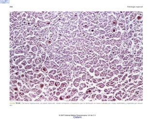 242 Patología especial
FIGURA 10-64. Carcinoma hepatocelular con patrón trabecular: células semejantes a hepatocitos que se distribuyen en masas rodeadas por células endoteliales y separadas por sinusoi-
des.
© 2007 Editorial Médica Panamericana, S.A de C.V.
Cisfarm
 