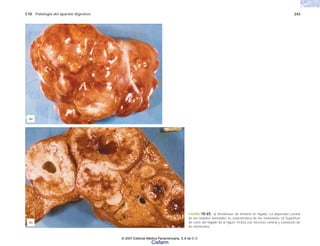 C10 Patología del aparato digestivo 243
FIGURA 10-65. a) Metástasis de timoma en hígado. La depresión central
de los nódulos tumorales es característica de las metástasis. b) Superficie
de corte del hígado de la figura 10-65a con necrosis central y cavitación de
las metástasis.
(b)
(a)
© 2007 Editorial Médica Panamericana, S.A de C.V.
Cisfarm
 